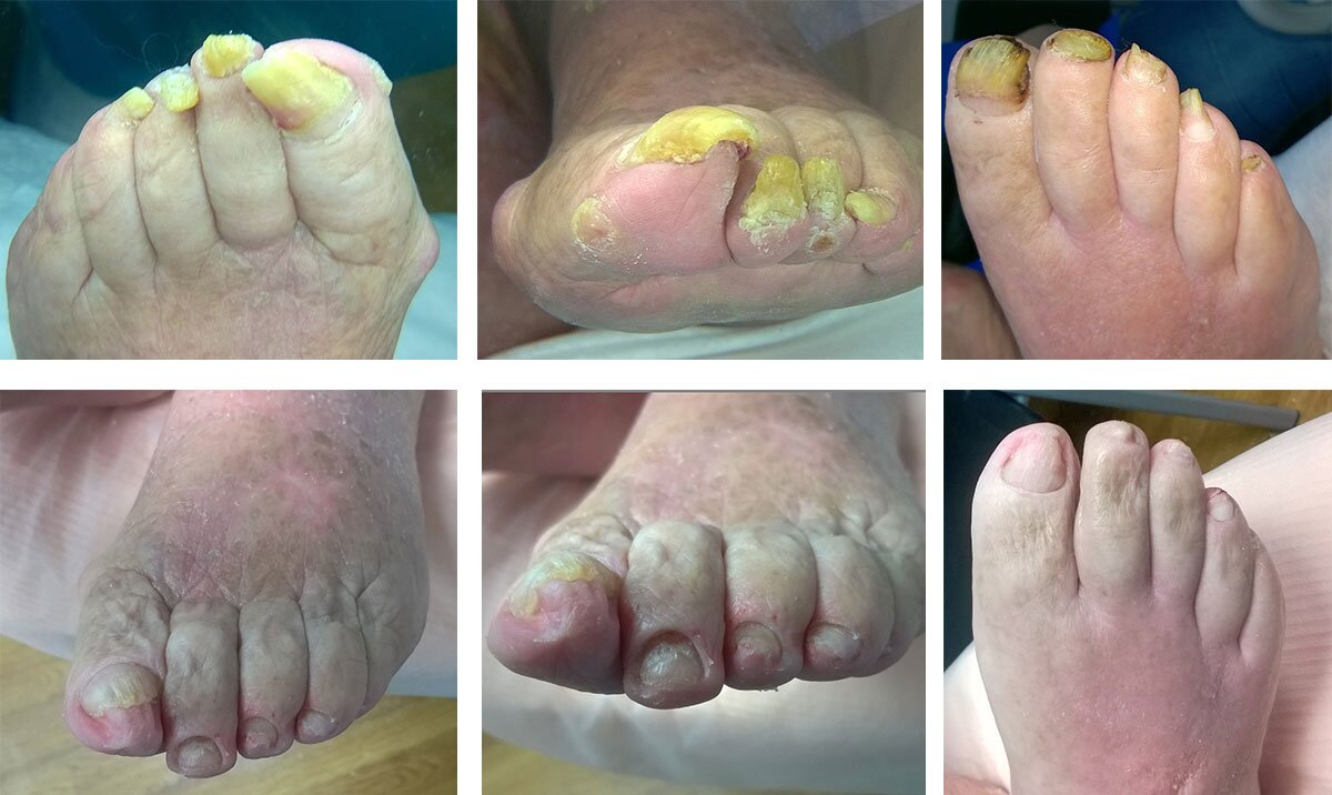 Onychogryfoza (Onychogryphosis), dystrofia paznokci (przed i po zabiegu)
