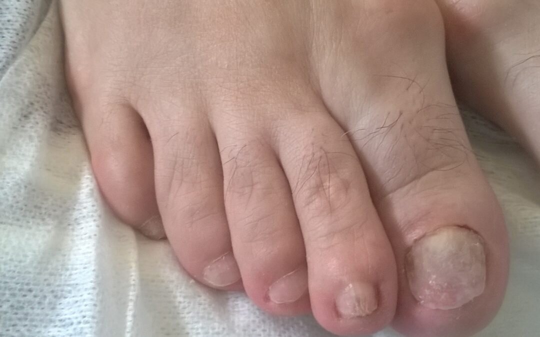 Rekonstrukcja płytki paznokcia